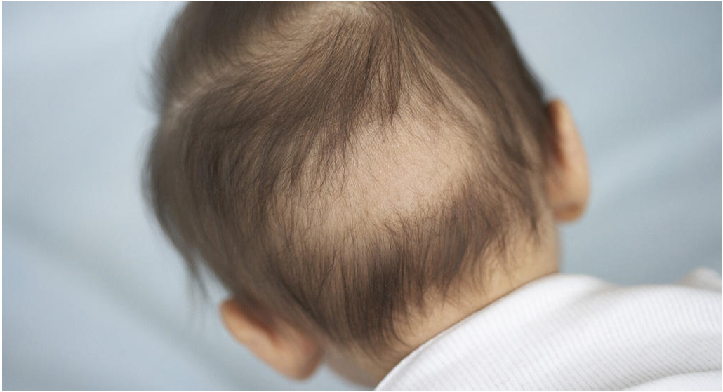 What Are The Main Causes Of Hair Loss In Children?